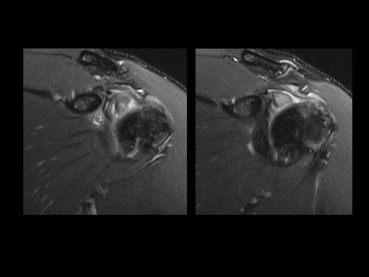 Figure 2 for case tendon of long head of biceps brachii ( RID1944 )